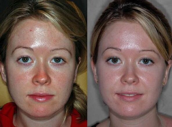 photographs before and after plasma rejuvenation procedure