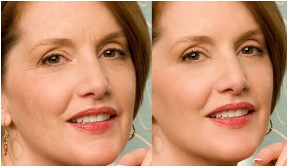 plasma before and after facial skin rejuvenation