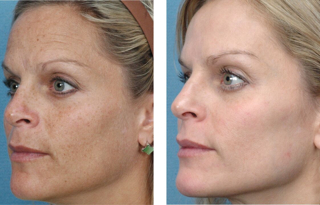 before and after skin rejuvenation Figure 1