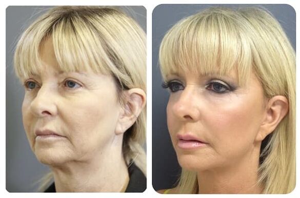 before and after skin rejuvenation with compression figure 2