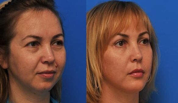 before and after skin rejuvenation with traction 1