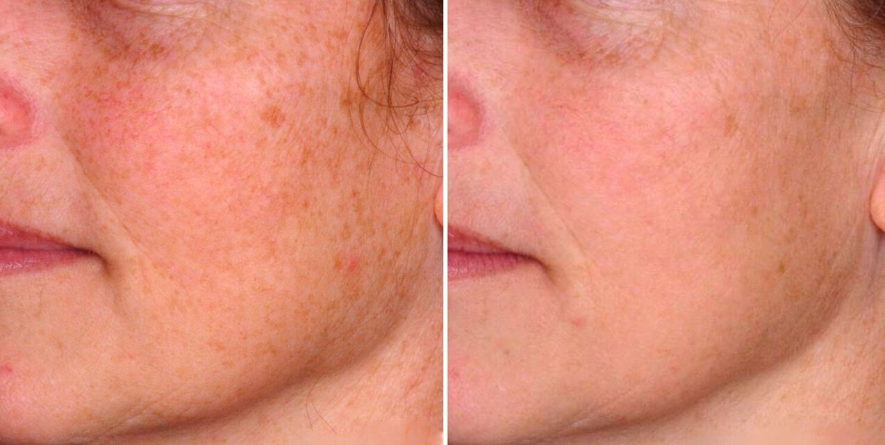 The result of fractional photothermolysis is the reduction of age spots on the skin. 