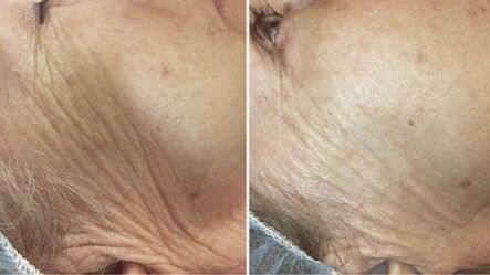 before and after laser skin rejuvenation
