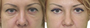 Pictures before and after eyelid contour