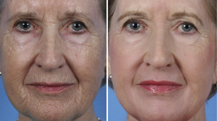 Fractional face rejuvenation before and after photos
