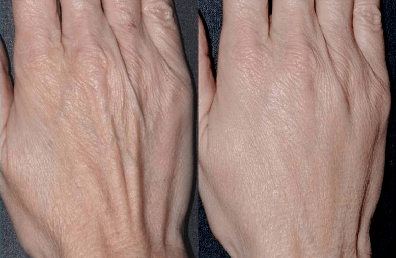 contour plastic, hand rejuvenation photo 2 before and after